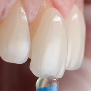 estetica dentale - terapia - Padova Dental Clinic