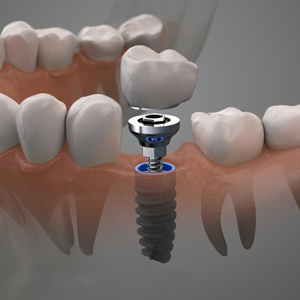 implantologia computer guidata - terapia - Padova Dental Clinic